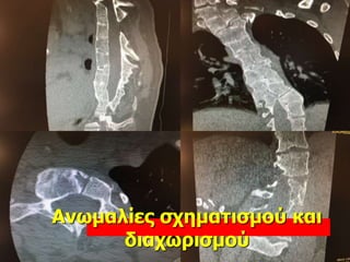 Ανωμαλίες σχηματισμού και
διαχωρισμού
 