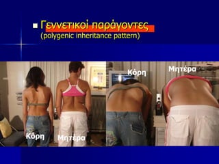  Γεννετικοί παράγοντες
(polygenic inheritance pattern)
ΜητέραΚόρη
Κόρη Μητέρα
 