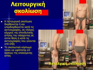 Λειτουργική
σκολίωση
Ανταλγική σκολίωση
 Η λειτουργική σκολίωση
διορθώνεται ή και
υπερδιορθώνεται κατά τις
ακτινογραφίες, σε πλάγιες
κάμψεις της σπονδυλικής
στήλης του πάσχοντος σε
ύπτια θέση ή κατά τις
ακτινογραφίες που γίνονται
υπό έλξη
 Το σκολιωτικό κύρτωμα
παύει να υφίσταται επί
άρσεως της υποκείμενης
αιτίας
 