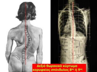 Δεξιό θωρακικό κύρτωμα
κορυφαίος σπόνδυλος 8ος ή 9ος
 