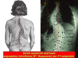 Διπλό οργανικό κύρτωμα
κορυφαίος σπόνδυλος 8ος θωρακικός και 2ος οσφυϊκός
 