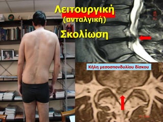 Λειτουργική
(ανταλγική)
Σκολίωση
Κήλη μεσοσπονδυλίου δίσκου
 
