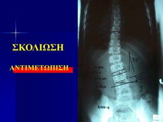 ΣΚΟΛΙΩΣΗ
ΑΝΤΙΜΕΤΩΠΙΣΗ
 