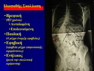 Ιδιοπαθής Σκολίωση
•Βρεφική
(0-3 χρόνια)
•Αυτοϊωμένη
•Επιδεινούμενη
•Παιδική
(4 μέχρι έναρξη εφηβείας)
•Εφηβική
(εφηβεία μέχρι επιφυσιακής
ωριμάνσεως)
•Ενήλικος
(μετά την σκελετική
ωρίμανση)
 