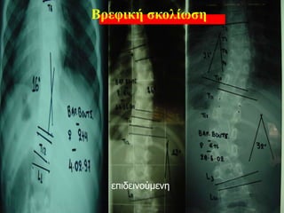 επιδεινούμενη
Βρεφική σκολίωση
 