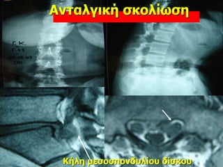 Κήλη μεσοσπονδυλίου δίσκου
Ανταλγική σκολίωση
 
