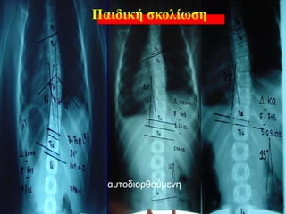 αυτοδιορθούμενη
Παιδική σκολίωση
 