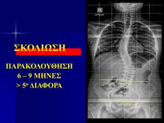 ΣΚΟΛΙΩΣΗ
ΠΑΡΑΚΟΛΟΥΘΗΣΗ
6 – 9 ΜΗΝΕΣ
> 5ο ΔΙΑΦΟΡΑ
 