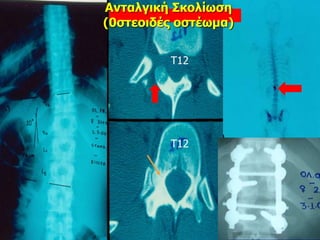 Τ12
Τ12
Ανταλγική Σκολίωση
(0στεοιδές οστέωμα)
 