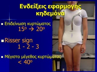 Ενδείξεις εφαρμογής
κηδεμόνα
 Επιδείνωση κυρτώματος
15ο  20ο
Risser sign
1 - 2 - 3
 Μέγιστο μέγεθος κυρτώματος
< 40ο
 