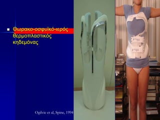  Θωρακο-οσφυϊκό-ιερός
θερμοπλαστικός
κηδεμόνας
Ogilvie et al, Spine, 1994
 