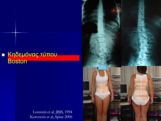  Κηδεμόνας τύπου
Boston
Lonstein et al, JBJS, 1994
Korovesis et al, Spine 2000
 