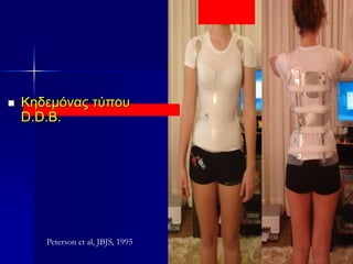 Peterson et al, JBJS, 1995
 Κηδεμόνας τύπου
D.D.B.
 