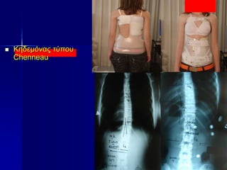  Κηδεμόνας τύπου
Chenneau
 