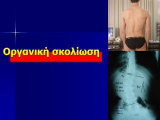 Οργανική σκολίωση
 