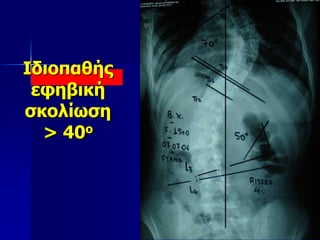 Ιδιοπαθής
εφηβική
σκολίωση
> 40ο
 
