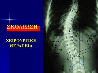 ΣΚΟΛΙΩΣΗ
ΧΕΙΡΟΥΡΓΙΚΗ
ΘΕΡΑΠΕΙΑ
Stable vertebra
neutral vertebra
 