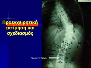 Προεγχειρητική
εκτίμηση και
σχεδιασμός
Stable vertebra
 