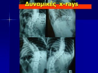 Δυναμικές x-rays
 