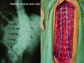 13 +2
Pedicle screws and rods
 