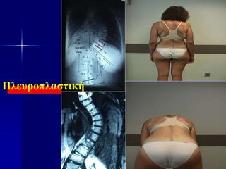 Πλευροπλαστική
 