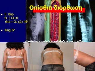 Μεγαλύτερος αριθμός σπονδυλοδεμένων επιπέδων
 Ε. Βαρ.
Θ – 13+0
Θ10 – Ο3 (Δ) 45ο
 King IV
Οπίσθια διόρθωση
 