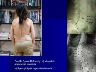 Double Spinal Deformity: a) Idiopathic
adolescent scoliosis
b) Spondylolysis - spondylolisthesis
 