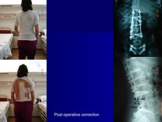 Post operative correction
 