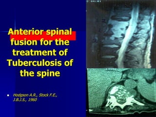  Hodgson A.R., Stock F.E.,
J.B.J.S., 1960
Anterior spinal
fusion for the
treatment of
Tuberculosis of
the spine
 