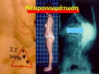 Νευροινωμάτωση
 