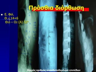 Μικρός αριθμός σπονδυλοδεμένων επιπέδων
 Ε. Φιλ.
Θ – 14+6
Θ10 – Ο2 (Α) 52ο
Πρόσθια διόρθωση
 