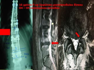 
16 χρόνια F-up Εκφύλιση μεσοσπονδυίου δίσκου
Ο4 – Ο5 υποκειμένου επιπέδου
 
