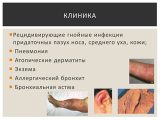 Рецидивирующие гнойные инфекции
придаточных пазух носа, среднего уха, кожи;
 Пневмония
 Атопические дерматиты
 Экзема
 Аллергический бронхит
 Бронхиальная астма
КЛИНИКА
 