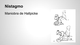 Nistagmo
Maniobra de Hallpicke
 