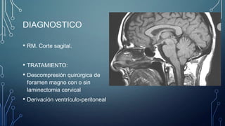 DIAGNOSTICO
• RM. Corte sagital.

• TRATAMIENTO:
• Descompresión quirúrgica de
foramen magno con o sin
laminectomia cervical

• Derivación ventrículo-peritoneal

 