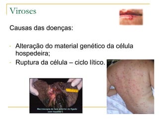 Viroses  Causas das doenças: Alteração do material genético da célula hospedeira; Ruptura da célula – ciclo lítico. 