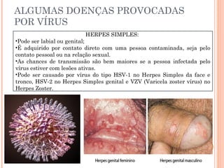ALGUMAS DOENÇAS PROVOCADAS
POR VÍRUS
                         HERPES SIMPLES:
•Pode ser labial ou genital;
•É adquirido por contato direto com uma pessoa contaminada, seja pelo
contato pessoal ou na relação sexual.
•As chances de transmissão são bem maiores se a pessoa infectada pelo
vírus estiver com lesões ativas. 
•Pode ser causado por vírus do tipo HSV-1 no Herpes Simples da face e
tronco, HSV-2 no Herpes Simples genital e VZV (Varicela zoster vírus) no
Herpes Zoster.
 
