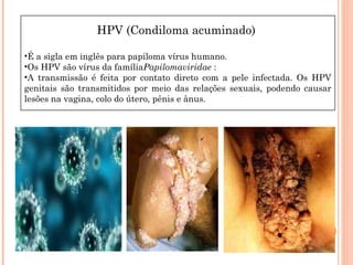 HPV (Condiloma acuminado)

•É a sigla em inglês para papiloma vírus humano.
•Os HPV são vírus da famíliaPapilomaviridae :
•A transmissão é feita por contato direto com a pele infectada. Os HPV
genitais são transmitidos por meio das relações sexuais, podendo causar
lesões na vagina, colo do útero, pênis e ânus.
 