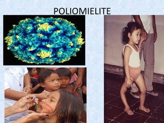 POLIOMIELITE
 