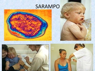 SARAMPO
 
