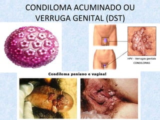 CONDILOMA ACUMINADO OU
VERRUGA GENITAL (DST)
 