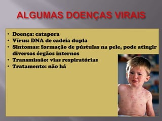 • Doença: catapora
• Vírus: DNA de cadeia dupla
• Sintomas: formação de pústulas na pele, pode atingir
diversos órgãos internos
• Transmissão: vias respiratórias
• Tratamento: não há

 