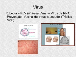 Vírus
Rubéola – RuV (Rubella Virus) – Vírus de RNA.
- Prevenção: Vacina de vírus atenuado (Tríplice
Viral)
 