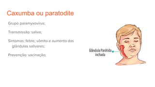 Caxumba ou paratodite
Grupo paramyxovírus;
Transmissão: saliva;
Sintomas: febre; vômito e aumento das
glândulas salivares;
Prevenção: vacinação;
 