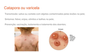 Catapora ou varicela
Transmissão: saliva ou contato com objetos contaminados pelas lesões na pele;
Sintomas: febre; enjoo, vômitos e bolhas na pele;
Prevenção: vacinação, isolamento e tratamento dos doentes;
 