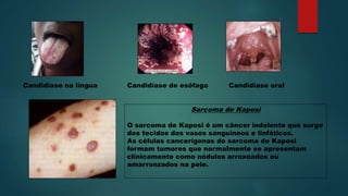 Candidíase de esôfagoCandidíase na língua Candidíase oral
Sarcoma de Kaposi
O sarcoma de Kaposi é um câncer indolente que surge
dos tecidos dos vasos sanguíneos e linfáticos.
As células cancerígenas do sarcoma de Kaposi
formam tumores que normalmente se apresentam
clinicamente como nódulos arroxeados ou
amarronzados na pele.
﻿
 