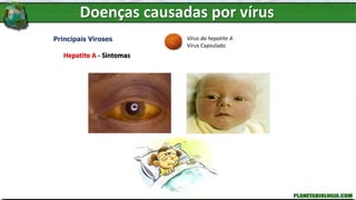 Doenças causadas por vírus
Principais Viroses
Hepatite A - Sintomas
Vírus da hepatite A
Vírus Capsulado
 