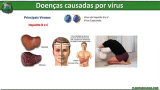 Doenças causadas por vírus
Principais Viroses
Hepatite B e C
Vírus da hepatite B e C
Vírus Capsulado
 