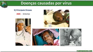 Doenças causadas por vírus
9) Principais Viroses
AIDS - Sintomas
 