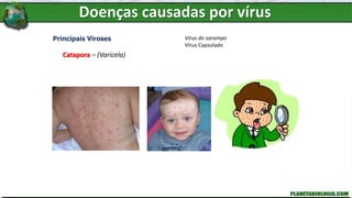 Doenças causadas por vírus
Principais Viroses
Catapora – (Varicela)
Vírus do sarampo
Vírus Capsulado
 